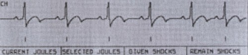 Graph of regular heartbeat